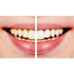 Pack Of 2 Dazzling White Hygienic Professional Strength Teeth Whitening Pens - Image 3