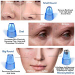 DermaSuction Vacuum Pore Cleaning Device With 4 Interchangeable Suction Heads - Image 9