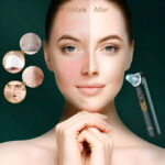 Turata USB Rechargeable Blackhead Remover Advanced Pore Vacuum With 3 Different Suction Levels - Image 2