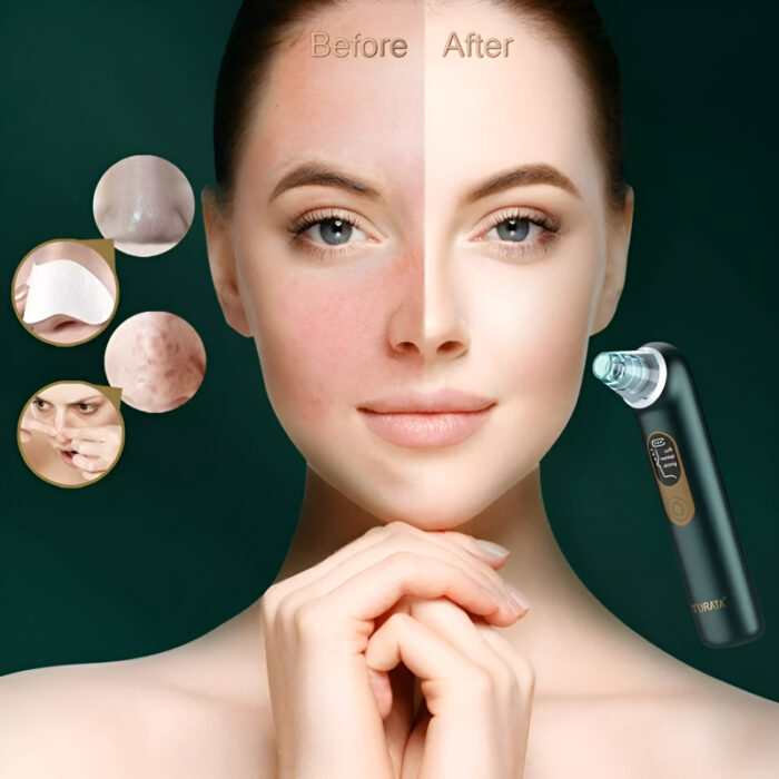 Turata USB Rechargeable Blackhead Remover Advanced Pore Vacuum With 3 Different Suction Levels - Image 2