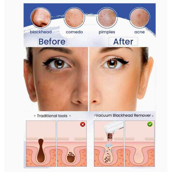 Turata USB Rechargeable Blackhead Remover Advanced Pore Vacuum With 3 Different Suction Levels - Image 13