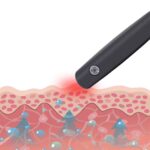 Mosquito Bite Helper – Insect Bite Relief, Useful For Summer, Helps Children, Insect Bites, Adults, Irritation, Itching, Neutralizer, Relieve Stings (Cell operated ) - Image 9