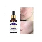 Aichun Beauty Medical Formula Anti-Acne Whitening Facial Serum-30ML - Image 5