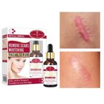 AICHUN BEAUTY Scar Removal Facial Serum Pimples Stretch Marks Face Moisturizing Body Remove Scars Kojic Acid Vitamin E 30ml - Image 2