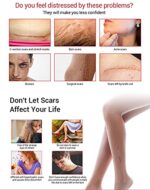 AICHUN BEAUTY Scar Removal Facial Serum Pimples Stretch Marks Face Moisturizing Body Remove Scars Kojic Acid Vitamin E 30ml - Image 4