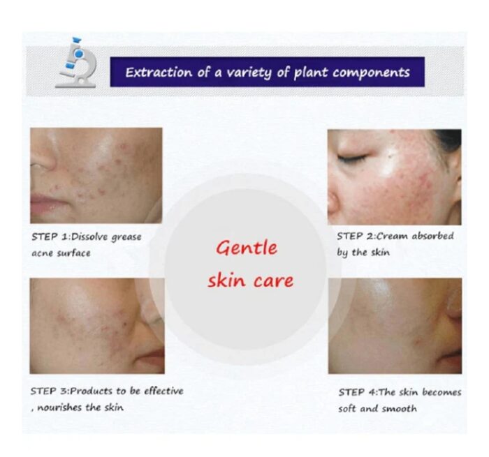 BIOAQUA Anti Acne Cleanser For Removal Of Acne - 100ml - Image 5