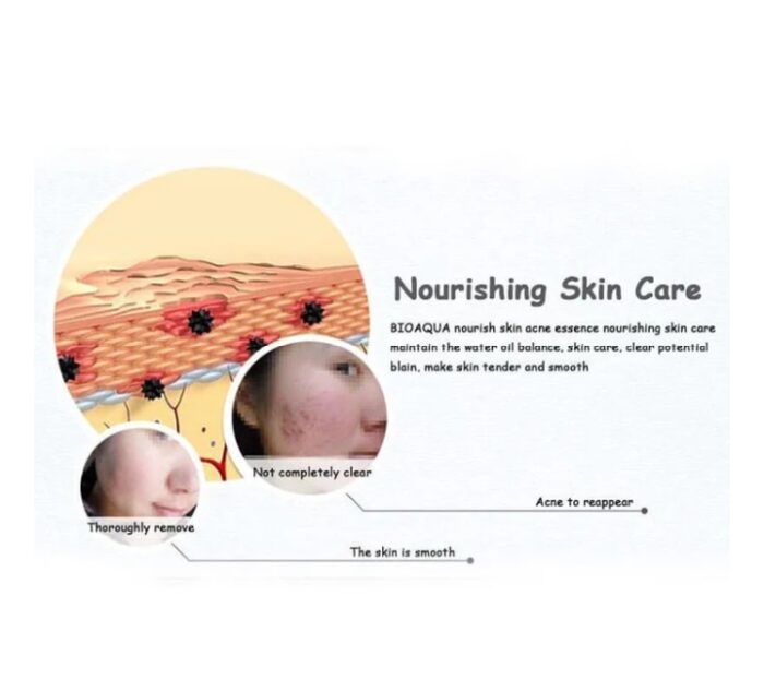 Bioaqua Anti-Acne Serum Removal Of Acne Essence Liquid 30ML - Image 6