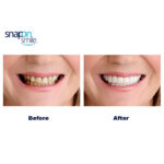 Pack Of 2 Pairs Snap-On Smile Custom Fit Perfect Smile Veneers In 3 Easy Steps - Image 6